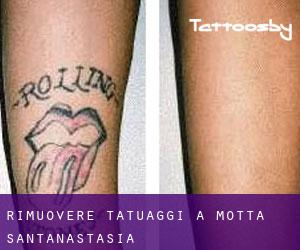 Rimuovere Tatuaggi a Motta Sant'Anastasia
