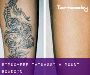 Rimuovere Tatuaggi a Mount Bowdoin