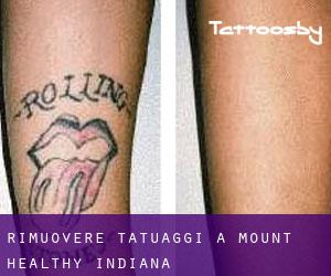 Rimuovere Tatuaggi a Mount Healthy (Indiana)