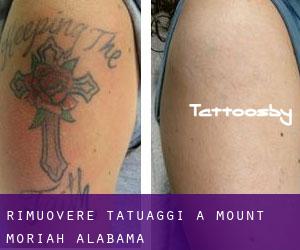 Rimuovere Tatuaggi a Mount Moriah (Alabama)