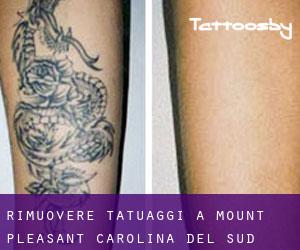 Rimuovere Tatuaggi a Mount Pleasant (Carolina del Sud)