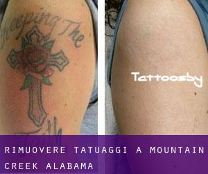 Rimuovere Tatuaggi a Mountain Creek (Alabama)