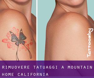 Rimuovere Tatuaggi a Mountain Home (California)