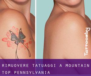 Rimuovere Tatuaggi a Mountain Top (Pennsylvania)