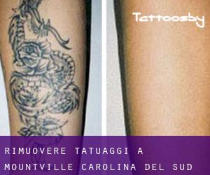 Rimuovere Tatuaggi a Mountville (Carolina del Sud)