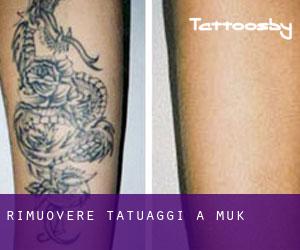 Rimuovere Tatuaggi a Mukō