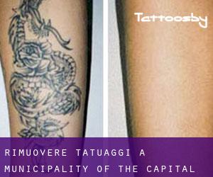 Rimuovere Tatuaggi a Municipality of the Capital