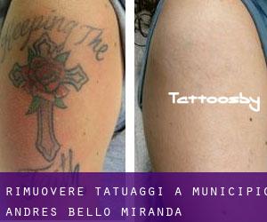 Rimuovere Tatuaggi a Municipio Andrés Bello (Miranda)
