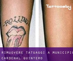 Rimuovere Tatuaggi a Municipio Cardenal Quintero