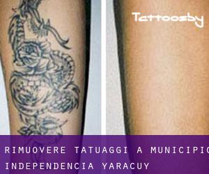Rimuovere Tatuaggi a Municipio Independencia (Yaracuy)