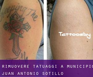 Rimuovere Tatuaggi a Municipio Juan Antonio Sotillo