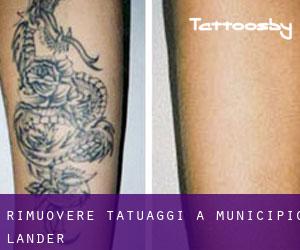 Rimuovere Tatuaggi a Municipio Lander