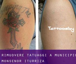 Rimuovere Tatuaggi a Municipio Monseñor Iturriza