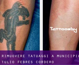 Rimuovere Tatuaggi a Municipio Tulio Febres Cordero