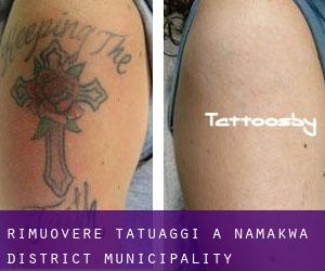 Rimuovere Tatuaggi a Namakwa District Municipality