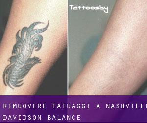 Rimuovere Tatuaggi a Nashville-Davidson (balance)