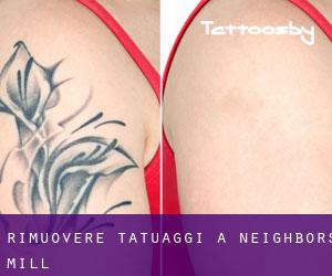 Rimuovere Tatuaggi a Neighbors Mill