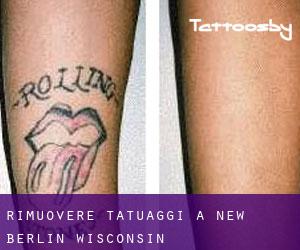 Rimuovere Tatuaggi a New Berlin (Wisconsin)