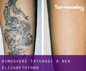 Rimuovere Tatuaggi a New Elizabethtown