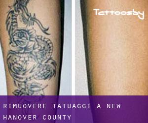 Rimuovere Tatuaggi a New Hanover County