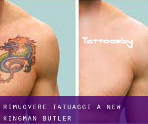 Rimuovere Tatuaggi a New Kingman-Butler