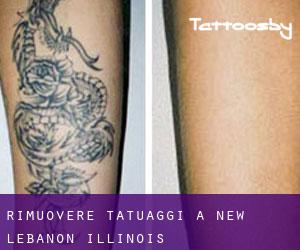 Rimuovere Tatuaggi a New Lebanon (Illinois)