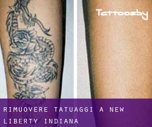 Rimuovere Tatuaggi a New Liberty (Indiana)