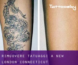 Rimuovere Tatuaggi a New London (Connecticut)