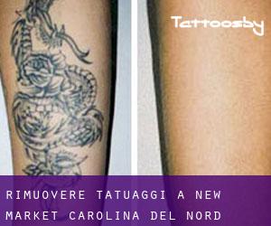 Rimuovere Tatuaggi a New Market (Carolina del Nord)