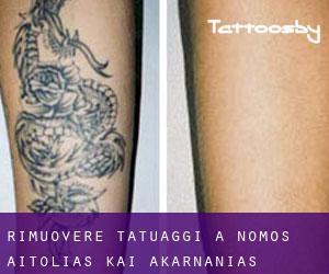 Rimuovere Tatuaggi a Nomós Aitolías kai Akarnanías