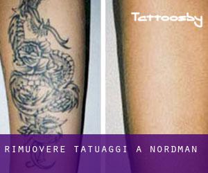 Rimuovere Tatuaggi a Nordman