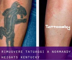 Rimuovere Tatuaggi a Normandy Heights (Kentucky)