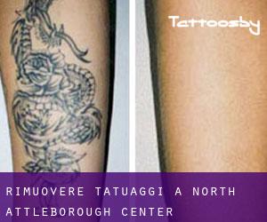 Rimuovere Tatuaggi a North Attleborough Center