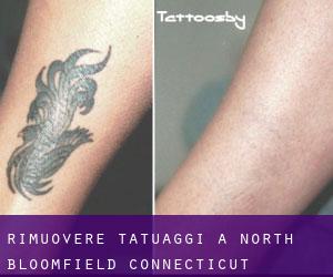 Rimuovere Tatuaggi a North Bloomfield (Connecticut)