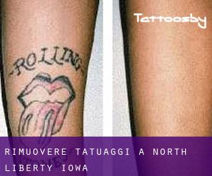 Rimuovere Tatuaggi a North Liberty (Iowa)