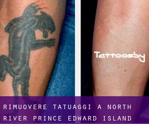 Rimuovere Tatuaggi a North River (Prince Edward Island)