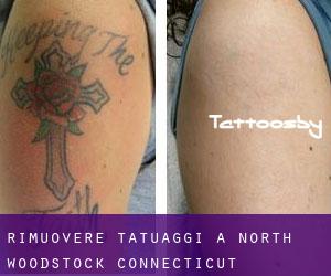 Rimuovere Tatuaggi a North Woodstock (Connecticut)