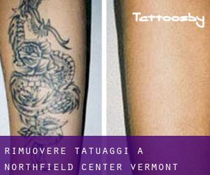 Rimuovere Tatuaggi a Northfield Center (Vermont)