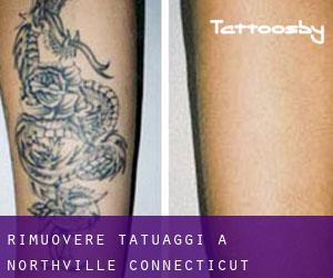Rimuovere Tatuaggi a Northville (Connecticut)