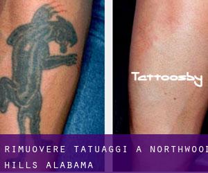 Rimuovere Tatuaggi a Northwood Hills (Alabama)