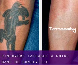 Rimuovere Tatuaggi a Notre-Dame-de-Bondeville