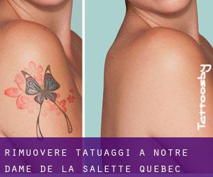 Rimuovere Tatuaggi a Notre-Dame-de-la-Salette (Quebec)
