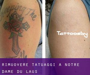 Rimuovere Tatuaggi a Notre-Dame-du-Laus