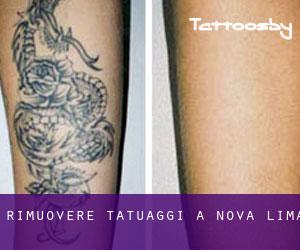 Rimuovere Tatuaggi a Nova Lima
