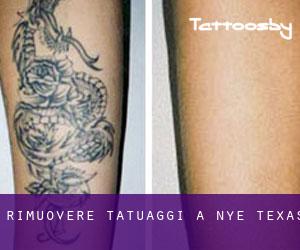 Rimuovere Tatuaggi a Nye (Texas)