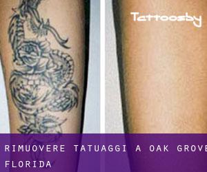 Rimuovere Tatuaggi a Oak Grove (Florida)