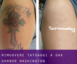 Rimuovere Tatuaggi a Oak Harbor (Washington)