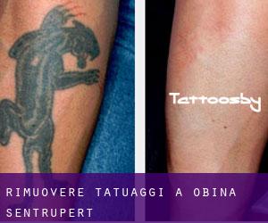 Rimuovere Tatuaggi a Občina Šentrupert