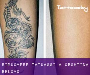 Rimuovere Tatuaggi a Obshtina Belovo