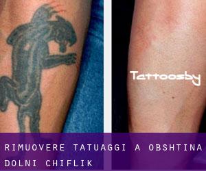 Rimuovere Tatuaggi a Obshtina Dolni Chiflik